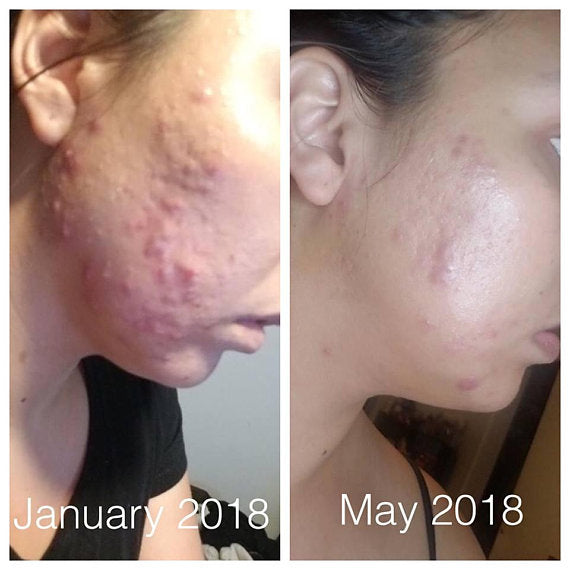 Organic Acne Fighter