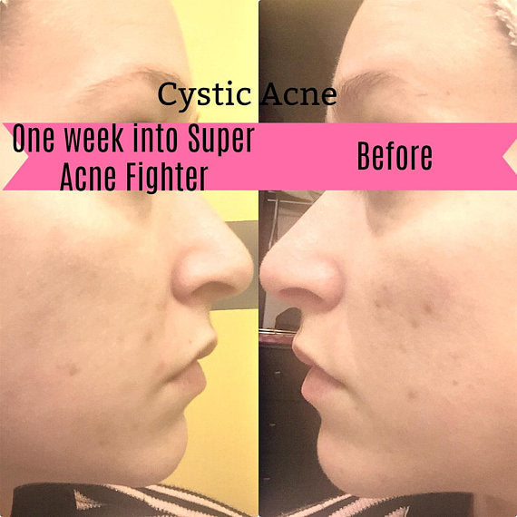 Organic Acne Fighter